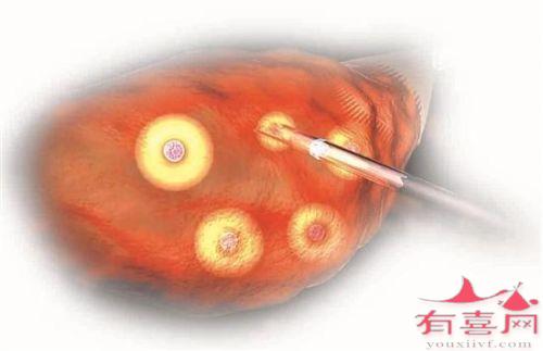 阴道超声检查和腹部超声检查哪个更好？为什么做赠卵试管供卵自怀的孕妈妈需要做阴道？