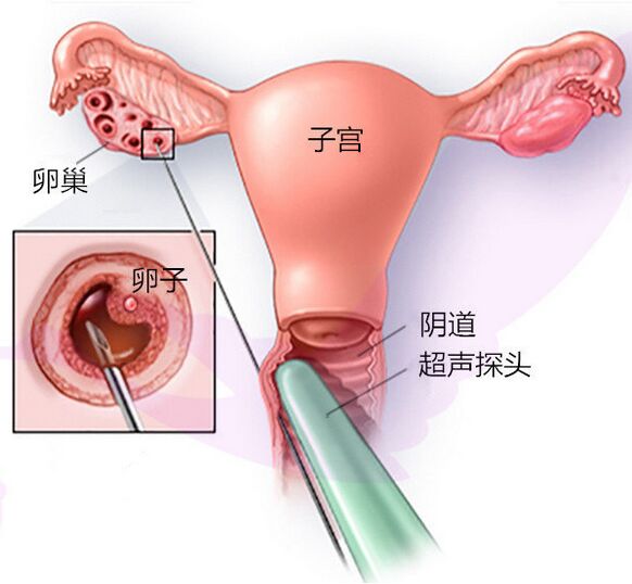 卵子质量才是赠卵二代代怀试管成功率的保障,提高卵子质量看这里