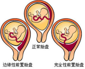 做供卵试管为什么要打降调